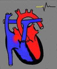 Atrial Septal Defect | Congenital Heart Disease - Cove Point Foundation |  Johns Hopkins Children's Hospital
