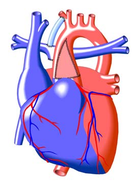 Damus-Kaye-Stansel Procedure