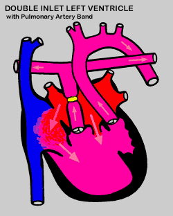 Double Inlet Left Ventricle