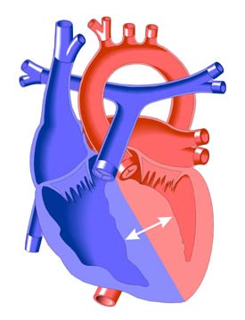 Hypertrophic Cardiomyopathy