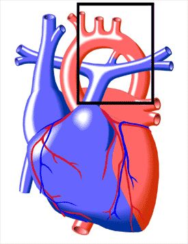 Patent Ductus Arteriosus | Congenital Heart Disease - Cove Point Foundation  | Johns Hopkins Children's Hospital