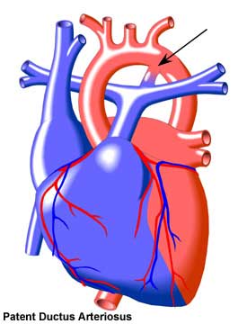 Patent Ductus Arteriosus