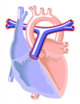 Pulmonary Hypertension