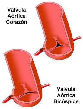 Bicuspid Aortic Valve