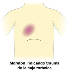 Bruise Indicating Trauma to Chest Wall