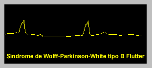 Wolfe-Parkinson-White Syndrome