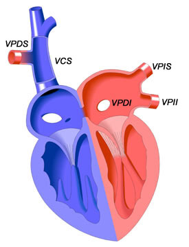 Drenaje Anómalo Parcial de Venas Pulmonares | Congenital Heart Disease -  Cove Point Foundation | Johns Hopkins Children's Hospital