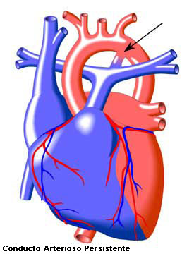 Conducto Arterioso Persistente