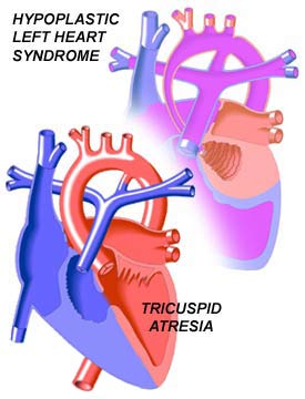 Single Ventricle