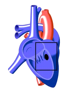 Ventricular Septal Defect | Congenital Heart Disease - Cove Point  Foundation | Johns Hopkins Children's Hospital